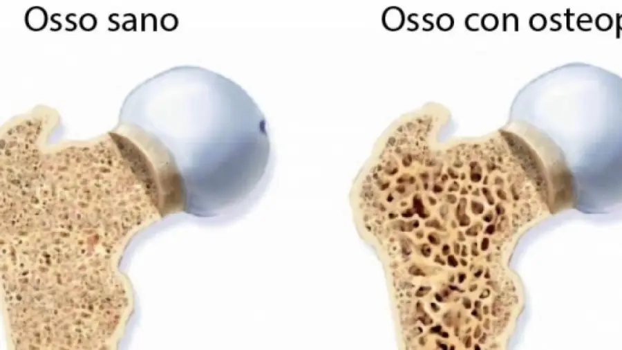 L'Osteoporosi