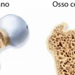 L'Osteoporosi