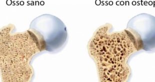 Osteoporosi