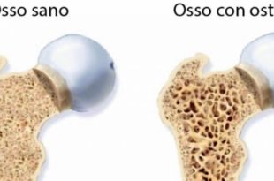 Osteoporosi