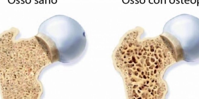 Osteoporosi