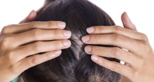 psoriasi cuoio capelluto
