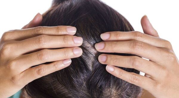 psoriasi cuoio capelluto